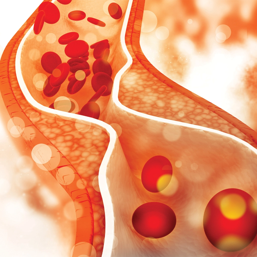 peripheral artery disease treatment