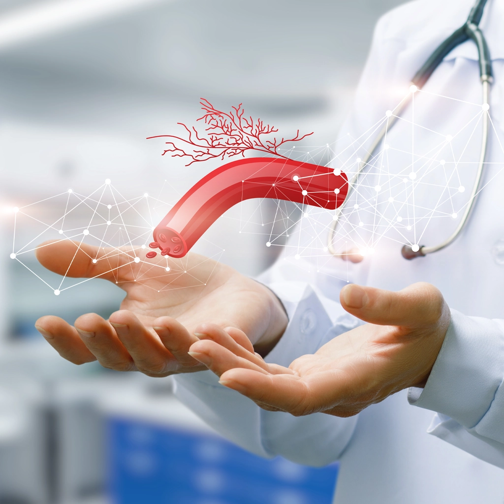 May-Thurner Syndrome treatments