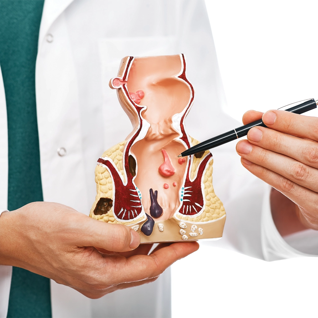 Chronic Hemorrhoids treatment