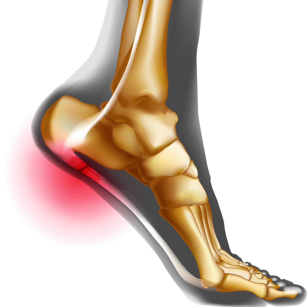 plantar fasciitis embolization