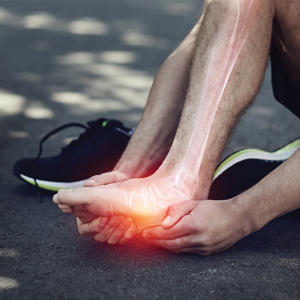 Plantar Fasciitis