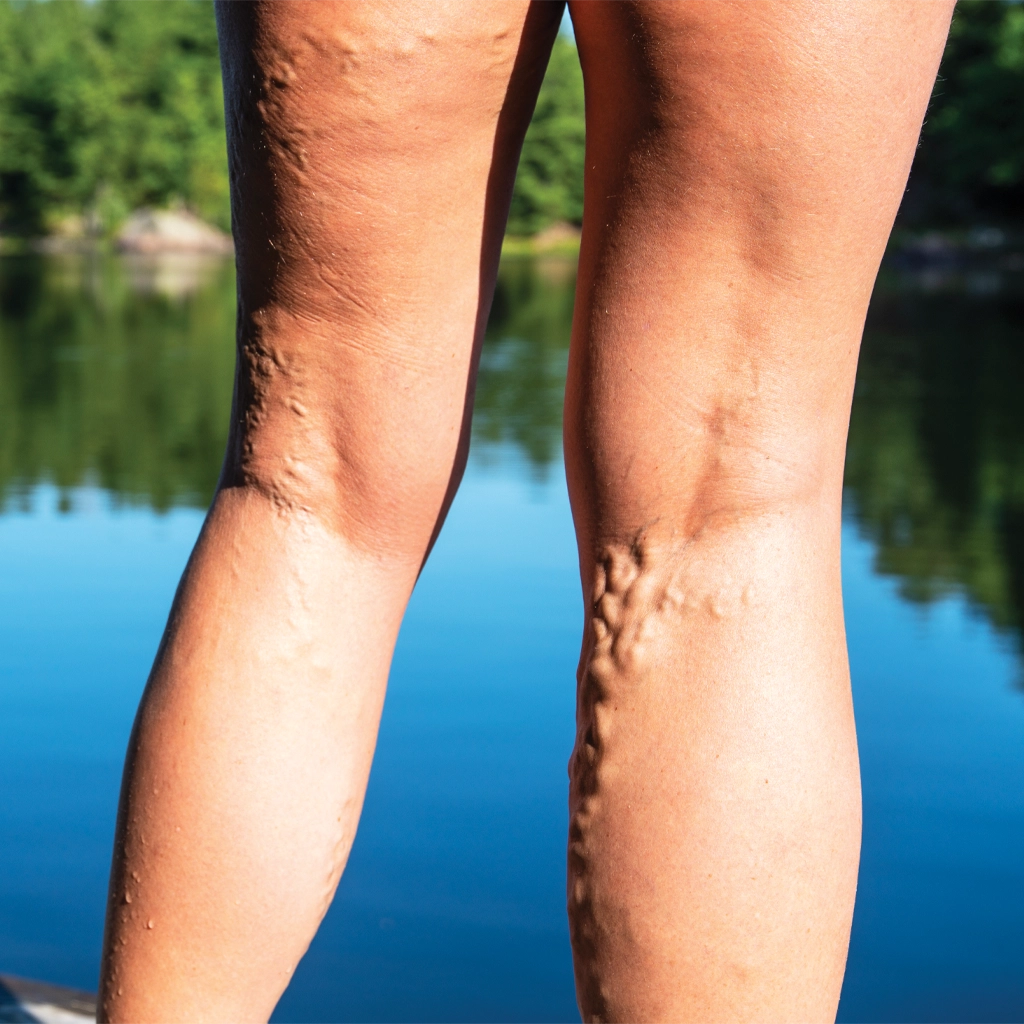 varicose vein treatment