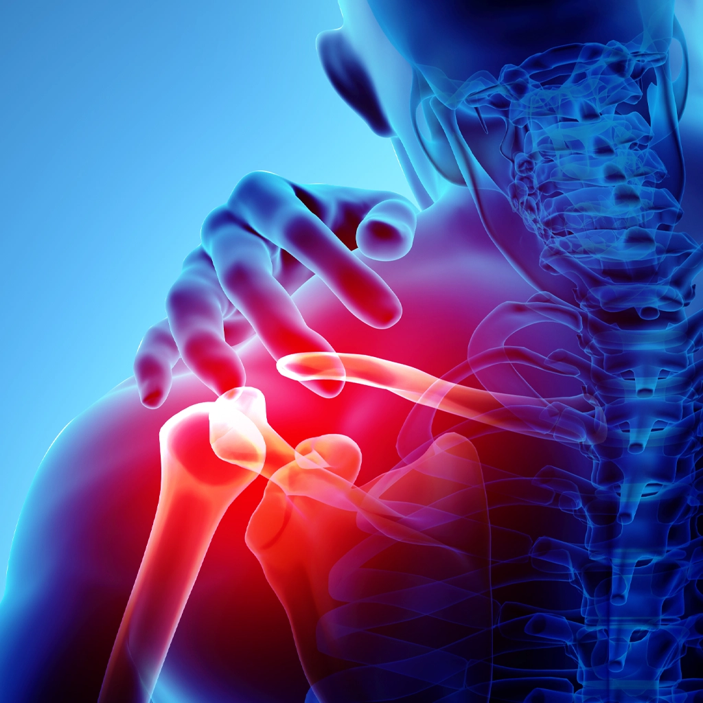 frozen shoulder embolization