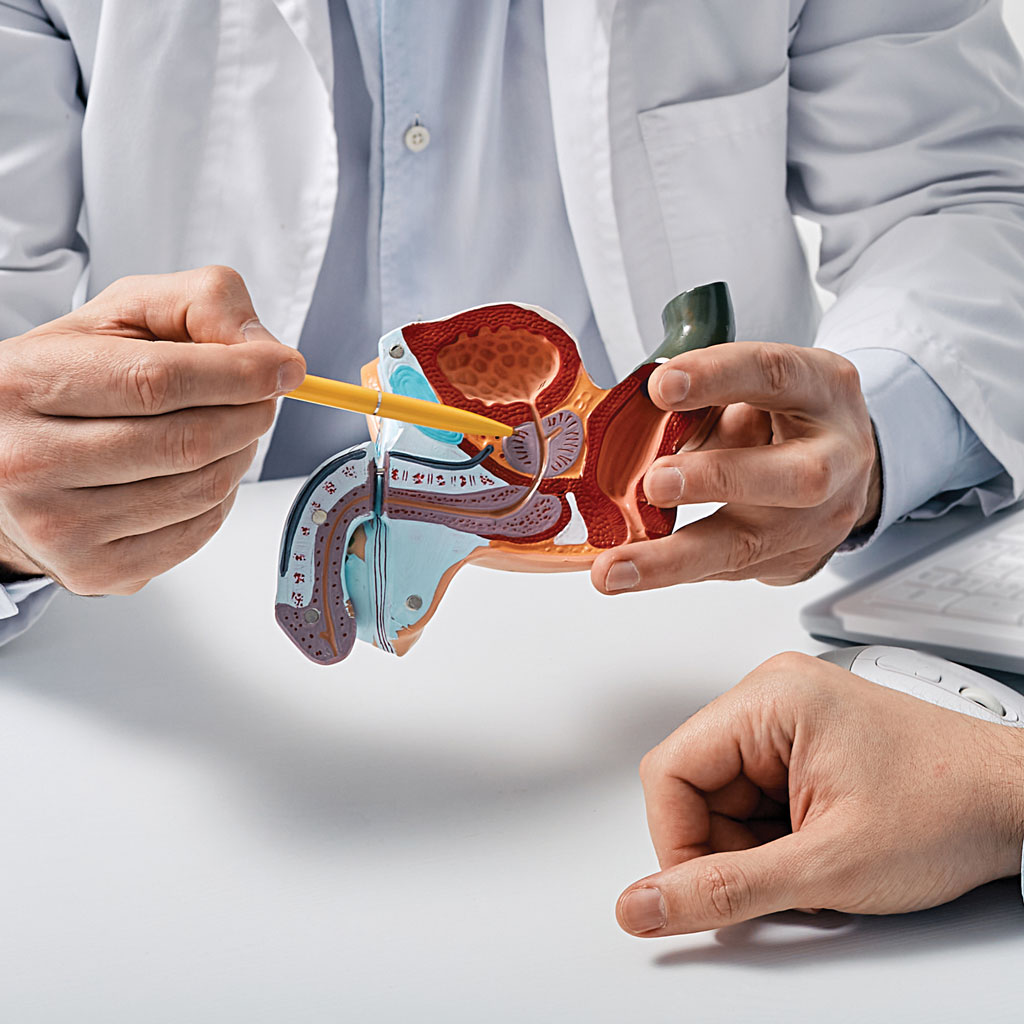 PAE vs TURP for BPH Doctor Showing Prostate Model