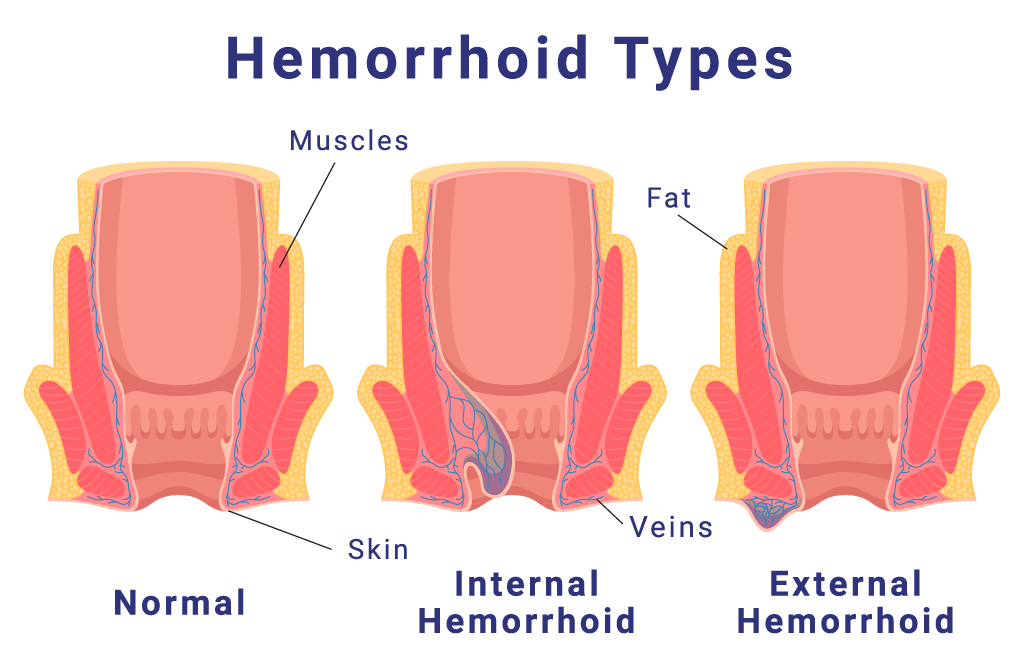types of hemorrhoids