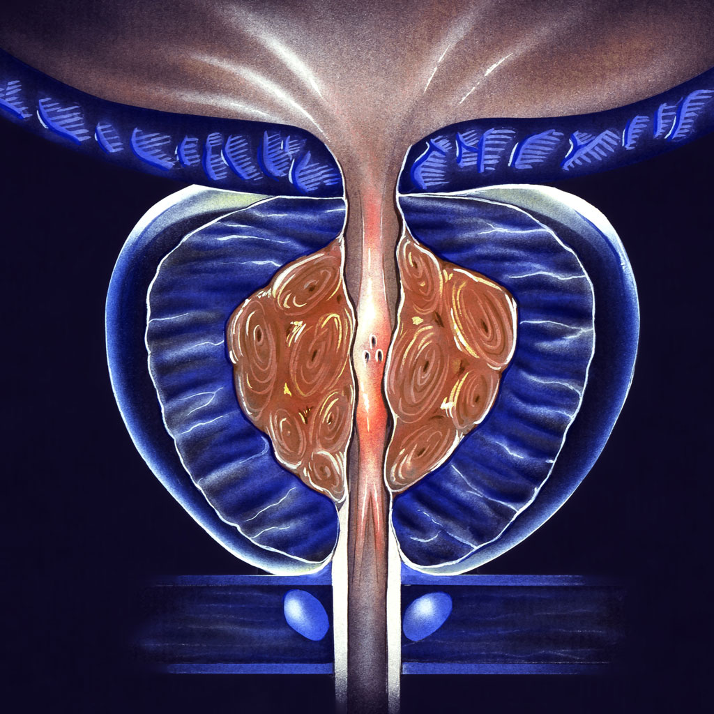 Signs of an Enlarged Prostate Illustration